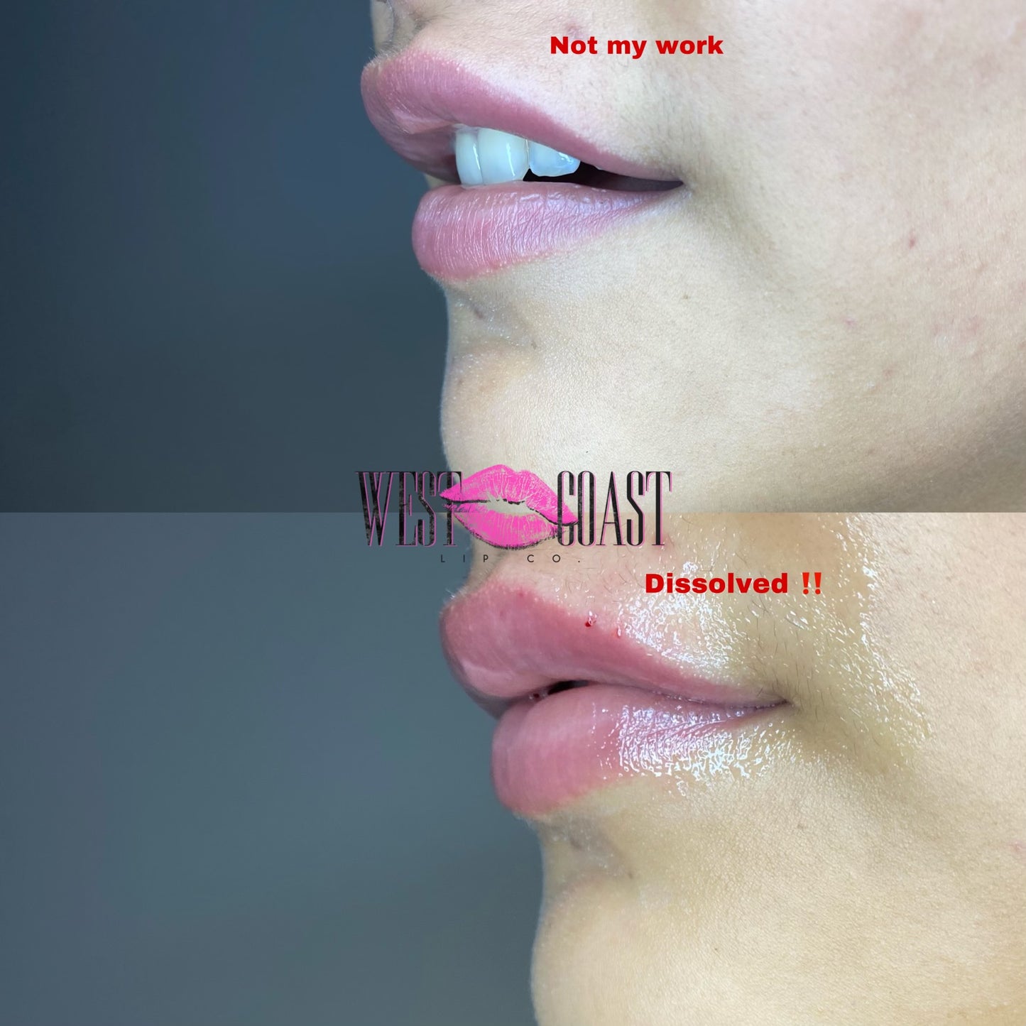 Online lip dissolve workshop